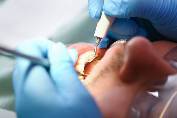 Best Broken or Cracked Tooth Emergency Dentist in Rushvle, IL