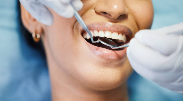Best Emergency Dentist for Lost Fillings or Crowns in Rushvle, IL